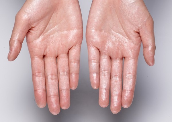Hyperhidrosis: Symptoms and Causes